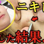 【肌荒れ ニキビ 鍼】女子大生あごと頬のニキビの原因はコレ　ニキビ・肌荒れはコレでほぼ100%治ります　美容鍼と小顔矯正もしたら凄すぎた　11円で自分で出来る方法も伝授【東京銀座　横浜元町　美容鍼】