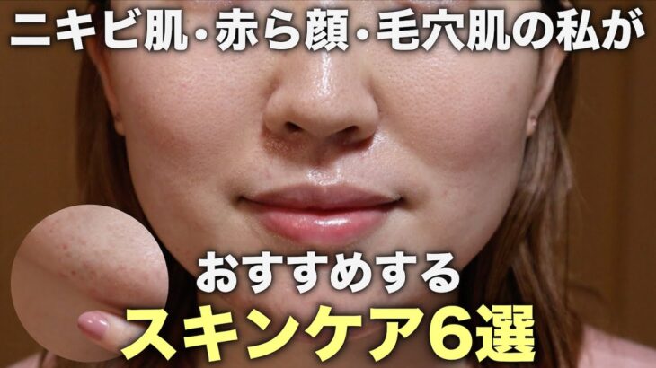 ニキビ肌•赤ら顔•毛穴肌がおすすめするスキンケア6選！角質ケア&クレンジング&パックなど