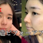 【毛穴悩んでる人見て❗️】美容ナースおすすめ最新肌治療✨ニキビ跡などポツポツ毛穴の救世主❗️ポテンツァの経過1週間追ってみた🧏🏻‍♀️#ニキビ跡 #スキンケア #美容皮膚科 #おすすめ