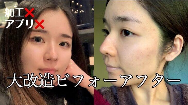 【毛穴悩んでる人見て❗️】美容ナースおすすめ最新肌治療✨ニキビ跡などポツポツ毛穴の救世主❗️ポテンツァの経過1週間追ってみた🧏🏻‍♀️#ニキビ跡 #スキンケア #美容皮膚科 #おすすめ