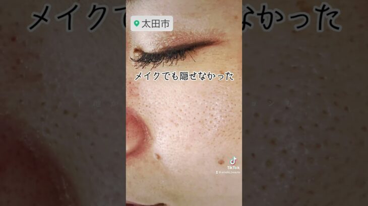 【頬のボコボコ毛穴・開き毛穴】改善した方法は美容医療治療では無くて、正しいケア方法と専用のスキンケア✨今では毛穴カバー下地もファンデーションも使用してません🙅‍♀️