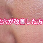 【必見】すり鉢毛穴に効いた美容医療&スキンケアをご紹介します！