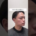 ニキビ男子がスキンケアを変えて2週間経ちました、良い調子です！#ニキビ