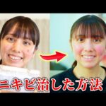 ニキビと肌荒れを改善した方法！本当に辛かった時期も😢【ニキビ】