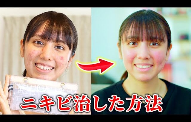 ニキビと肌荒れを改善した方法！本当に辛かった時期も😢【ニキビ】