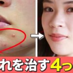 【大人ニキビを治す】肌荒れを改善させる4つのポイントを詳しく解説します！