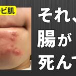 大人ニキビの原因は「腸」原因かも…。解決策まで教えます！