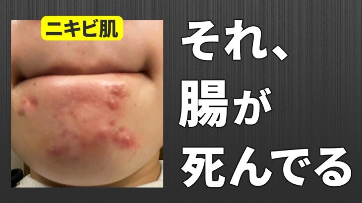 大人ニキビの原因は「腸」原因かも…。解決策まで教えます！