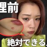 生理前の大人ニキビを圧倒的に減らす方法！【スキンケア】【食事改善】