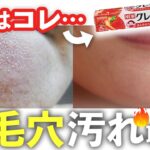 【あごニキビで悩んでる人必見！】何をしても治らなかった「あごプツプツ」の治し方！ #角栓 #毛穴の詰まり