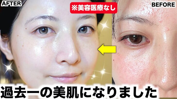 【冬スキンケア】毛穴も肌荒れもひどかった私が圧倒的美肌を手に入れたスキンケアルーティン【乾燥肌】