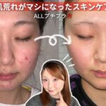 【NO案件‼️】肌荒れが落ち着いたスキンケア🧖🏻‍♀️🩵｜ニキビ｜ニキビ跡｜赤み