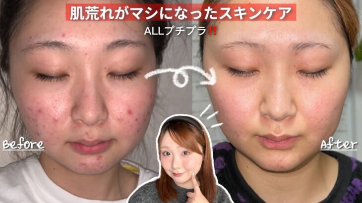 【NO案件‼️】肌荒れが落ち着いたスキンケア🧖🏻‍♀️🩵｜ニキビ｜ニキビ跡｜赤み